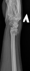 An X-ray of a fractured human bone in motion. Skeleton Anatomy