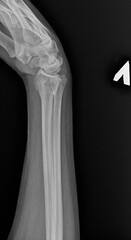 X-ray image of cracked human bone. Wrist fracture