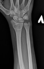 X-ray of the restored bones of the man's hand after breaking and removing plaster