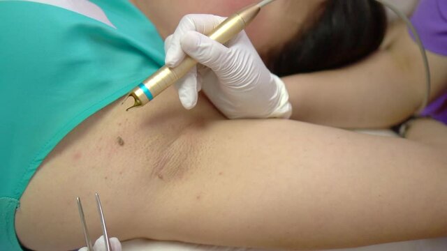 Papilloma on skin. Removing papilloma with laser. Beautician treatment.