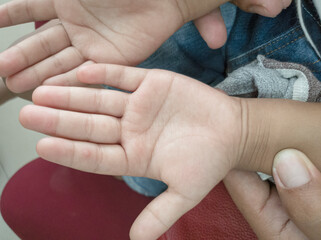 Hand-foot-and-mouth disease, closeup view of macular lesion on child palm , support by mothor hand