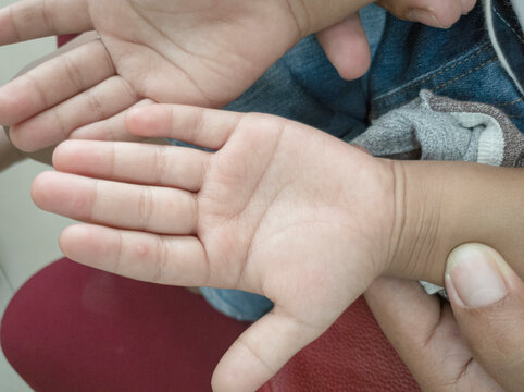 Hand-foot-and-mouth disease, closeup view of macular lesion on child palm , support by mothor hand