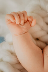 Polydactyly which is a congenital limb malformation on a newborn baby with six fingers on one hand
