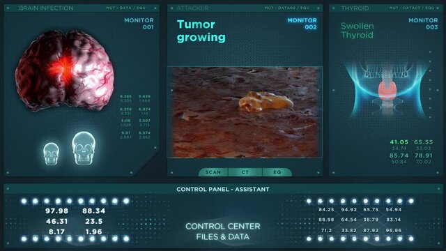 Tumor growing medical HUD. Futuristic medicinal image diseases for healthcare and hospital use, magnetic Z ray read for MRI and CT diagnosis and treatment of head trauma, cancer and other disease
