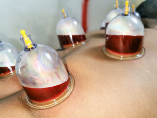 cupping or hijama therapy is under process on the back of a laying patient 