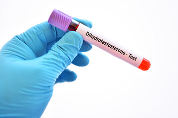 Obraz premium Test tube with blood sample for dihydrotestosterone or DHT hormone test