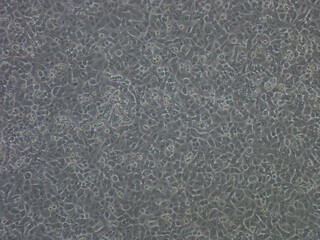 Untreated Human Lung Adenocarcinoma, Cell line close up 10x. Seamless medical background.