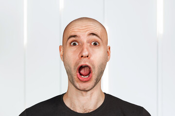 Confused young bald man with alopecia. guy skin head with hair loss want transplant with open mouth