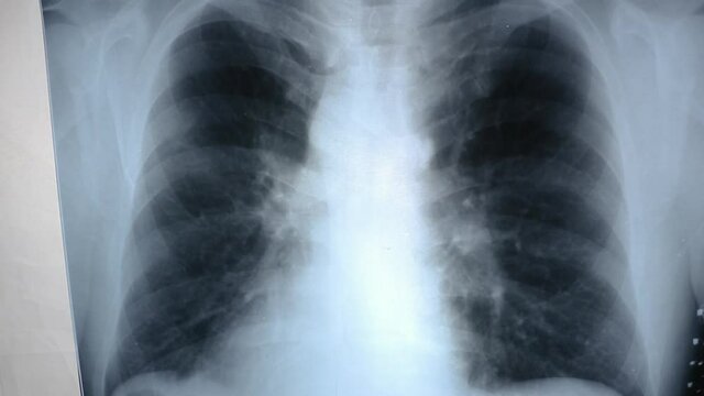 x-ray of lungs close-up view. concept of medical exam at hospital and diagnostic of pneumonia and cancer