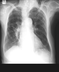 Chest x-rays durring lungs Tuberculosis also called as MTB or TB 