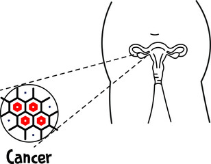 Illustration of Ovarian cancer ovary cyst cancer cells enlarged in microscope view zoom in
