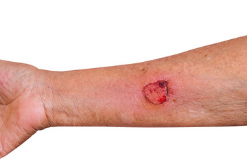 Wound was hot water scalded and Inflammation on elderly woman arm isolated on white background , clipping path