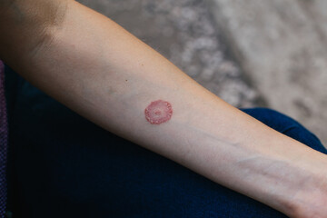 Ring Worm infection, Dermatophytosis on skin. Applying an emollient to dry flaky skin
