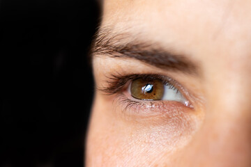 Macro eye photo. Keratoconus - eye disease, thinning of the cornea in the form of a cone. The...