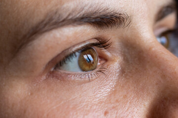 Keratoconus of both eyes, 2nd and 4th degree. Contortion of the cornea in the form of a cone,...