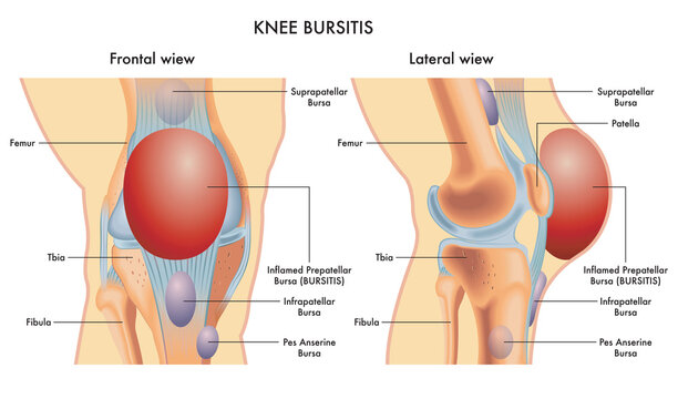 Medical illustration of a knee with an inflamed prepatellar bursa (BURSITIS) viewed frontally and laterally, with annotations.