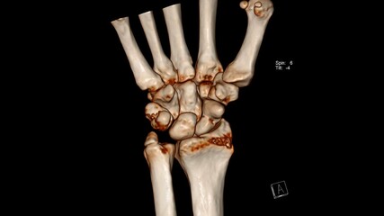 Radiology examination, Computed Tomography Volume Rendering examination of the wrist joint ( CT VR...
