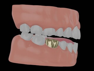 human jaw with gold tooth, golden crown of a molar, 3d render