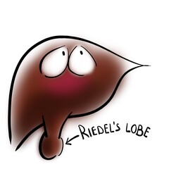 Riedel's lobe of the liver