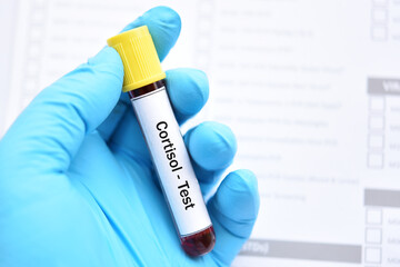 Test tube with blood sample for cortisol hormone test