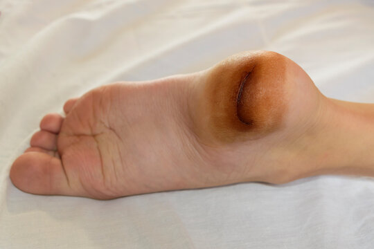 Heel injury. Child's leg cut. Concept of being injured by glass or metal while swimming.