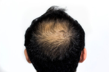 male person lost his top hair,  starting to get bald