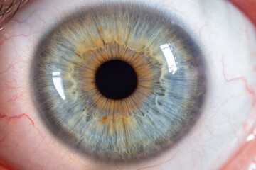 Heterochromia