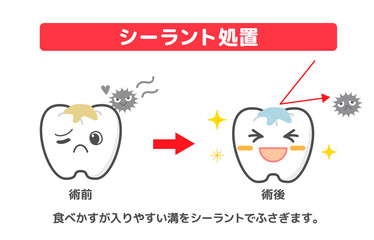 illustrations of dental sealants treatment before after