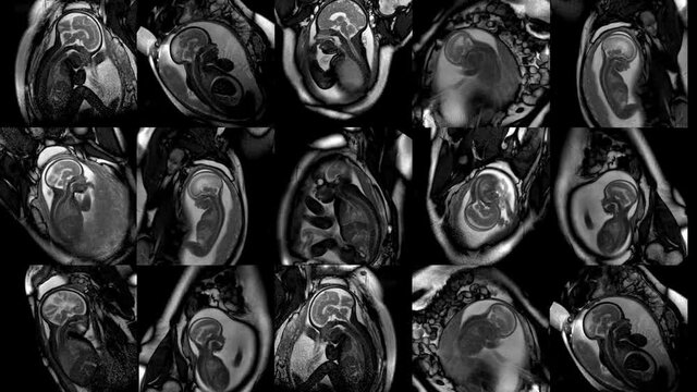 Stock Video Footage human embryo in the womb