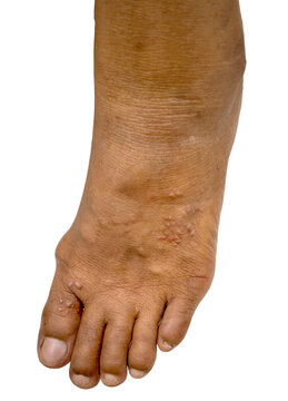 multiple vesicles skin lesion at  foot ,herpes zoster infection
