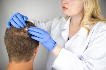 A trichologist examines the hair of a man who begins alopecia. Consultation with a dermatologist. Hair loss, alopecia, pruritus, burning head or seborrhea - obrazy, fototapety, plakaty