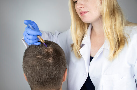 The doctor trichologist conducts mesotherapy or plasma therapy. Treatment of alopecia. Hair loss, alopecia, pruritus, burning head or seborrhea