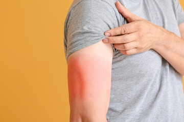 Man with red sunburned skin against color background, closeup