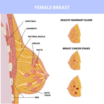 Chart showing breast cancer. Vector illustration, female realistic breasts.