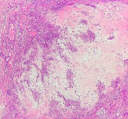 Photo of pleomorphic adenoma (salivary gland tumor), consisting of epithelial and myxochondroid components, magnification 100x, photo under microscope