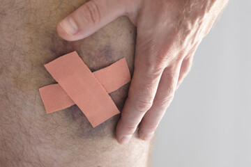 man with big bruise on the thigh. big bruise with bandage. Big blue spot