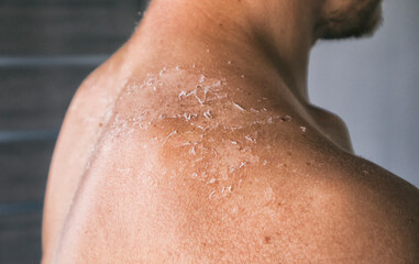 The dry and itching man's skin after sunbath