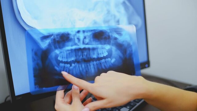 Dentist doctor checking dental x-ray orthopantomogram. Dental panoramic radiography
