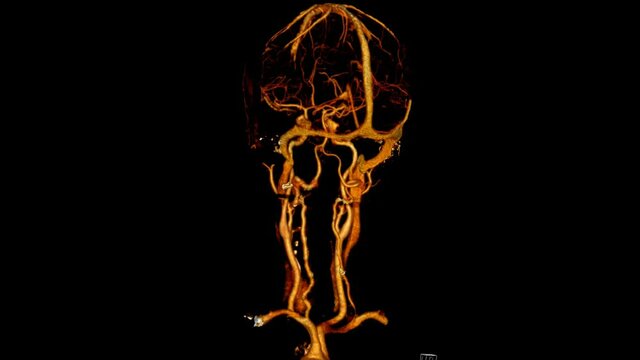 Computed Tomography of the Carotid and Intracranial arteries volume rendering in cine mode (CT carotids)