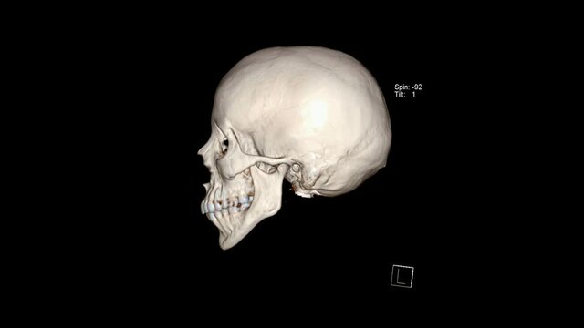 Computed Tomography of the facial bones in 3D rendering (CT VR facial bones)