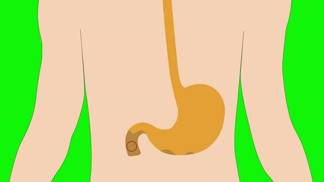 Animation of human stomach acid , Acid reflux in Stomach
