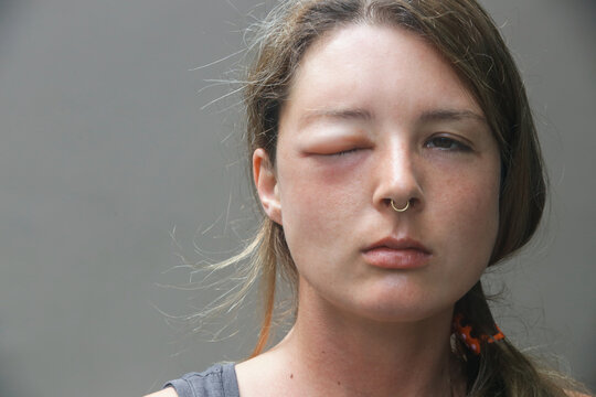 Young Caucasian Woman With A Swollen Eye From A Wasp's Sting. Allergy Reaction On Wasp Bite.	