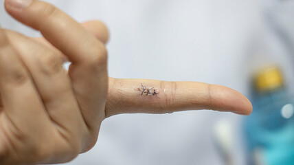 Surgical stitches of a woman's finger after Dissected the excess lump.