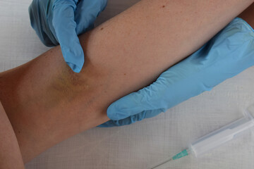 Dark big bruise on the arm as result of doctor mistake taking the blood with syringe from vein.