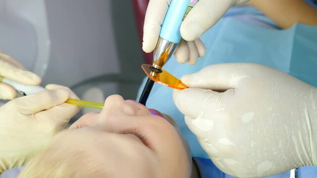 Health concept. Boy at dental clinic gets dental treatment to fill a cavity in tooth. Top view. Dental restoration and material polymerization with UV light. 4 k video