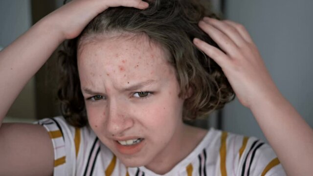 The girl carefully looks in the mirror at her face. She is very upset by teenage acne.