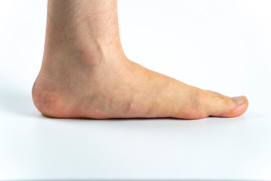 An advanced flat feet (pes planus or fallen arches) medical condition