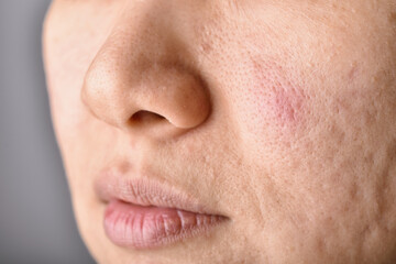 Skin problem with acne diseases, Close up woman face with acne marks and allergy red rash, Scar and oily greasy face, Healthcare and beauty concept.