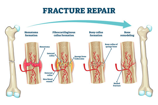 Fracture Repair As Educational Bone Remodeling Formation Vector Illustration