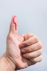 Bleeding blood from the cut finger wound. Injured finger with bleeding open cut wound. Closeup of...